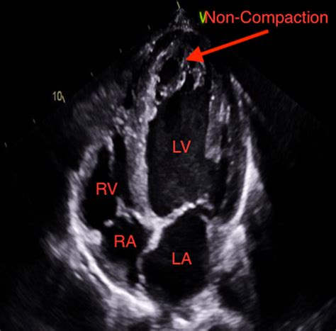 lv non compaction syndrome.